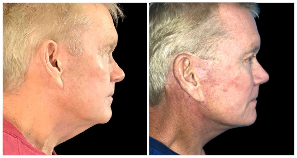 Before and after side view of a face lift