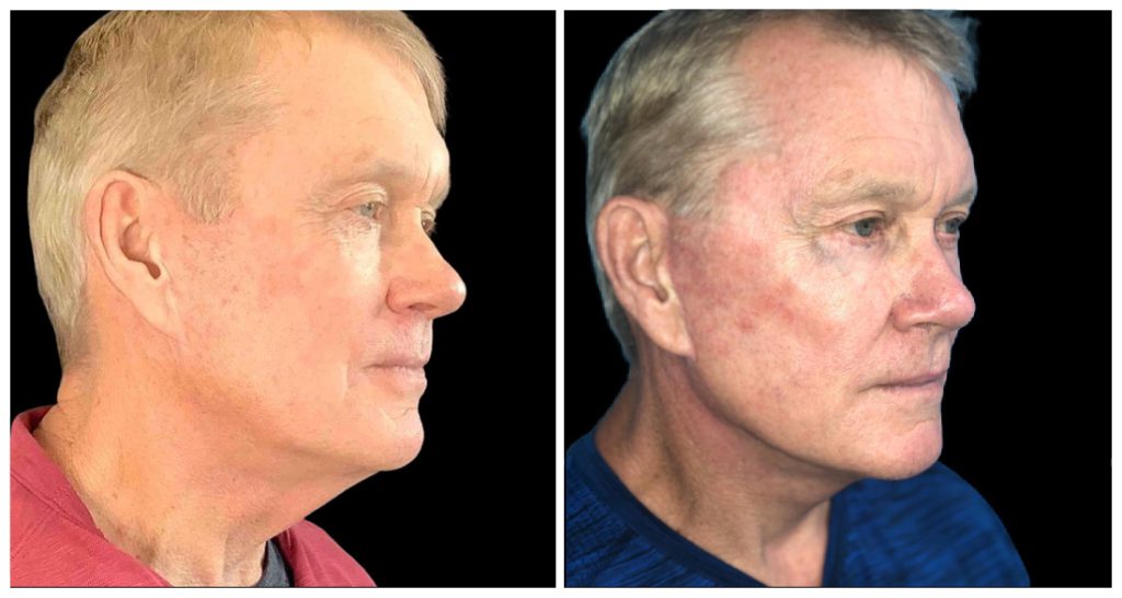 Before and after front view of a face lift