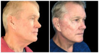Before and after front view of a face lift