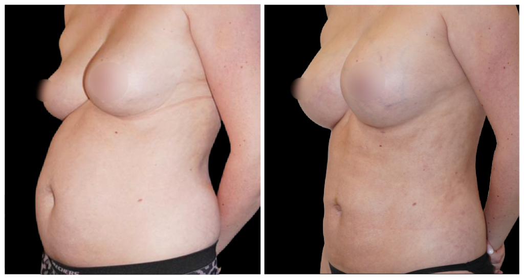 Fat Transfer to Breast before and after result