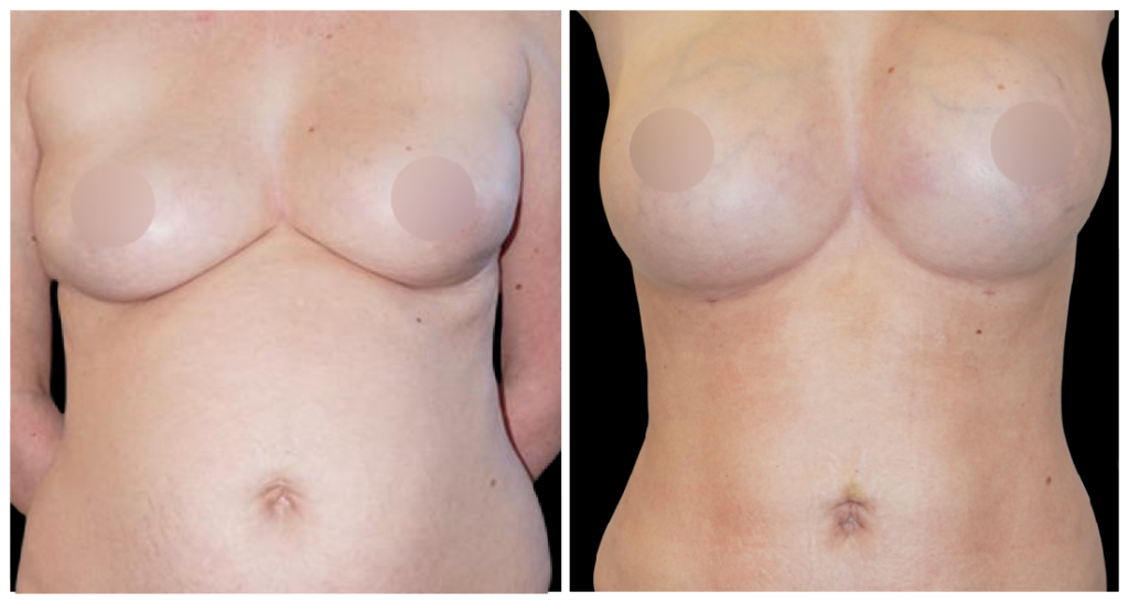 Fat Transfer to Breast before and after result