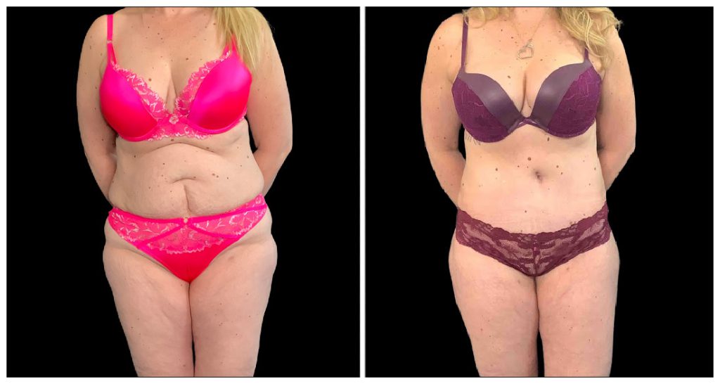 Fat Transfer to Body before and after result