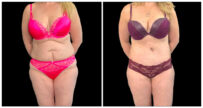 Fat Transfer to Body before and after result