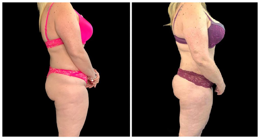 Fat Transfer to Body before and after result