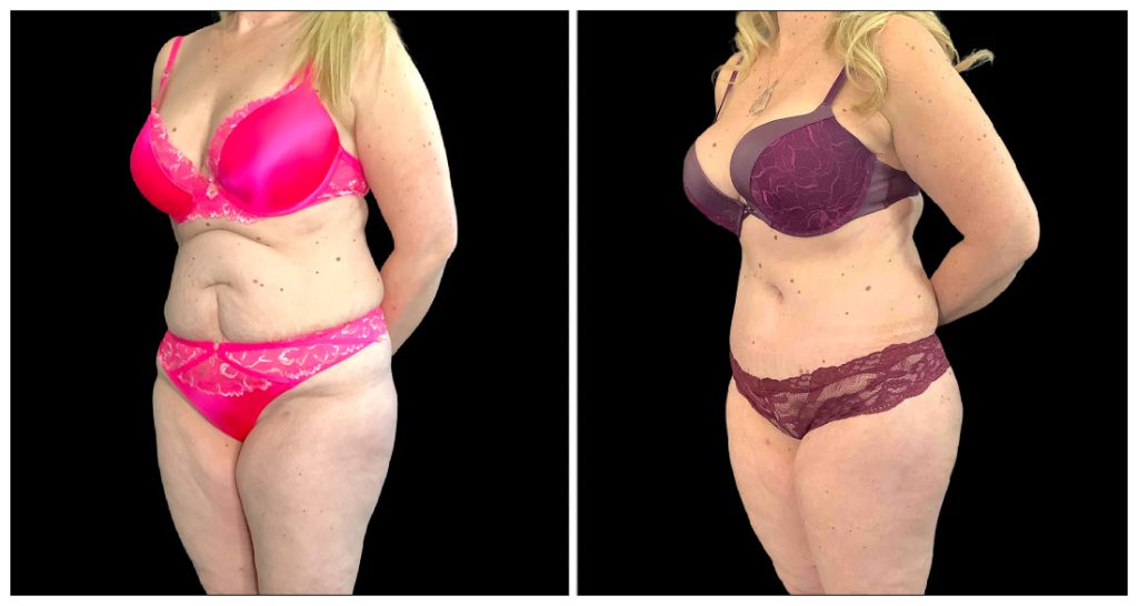 Fat Transfer to Body before and after result
