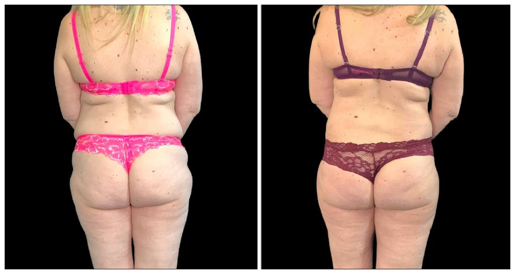 Fat Transfer to Body before and after result