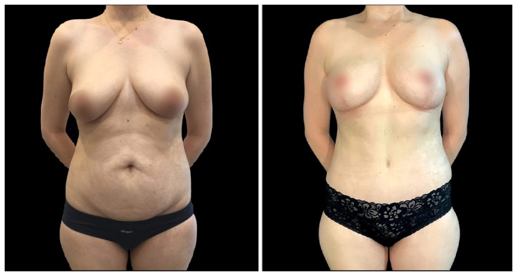 Fat Transfer to Breast before and after result