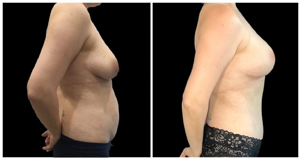 Fat Transfer to Breast before and after result