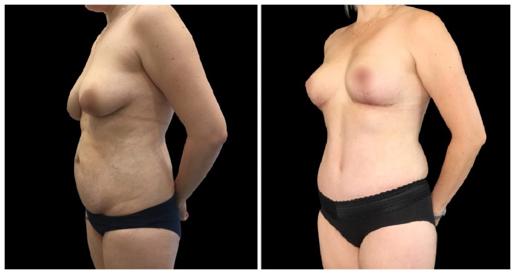 Fat Transfer to Breast before and after result