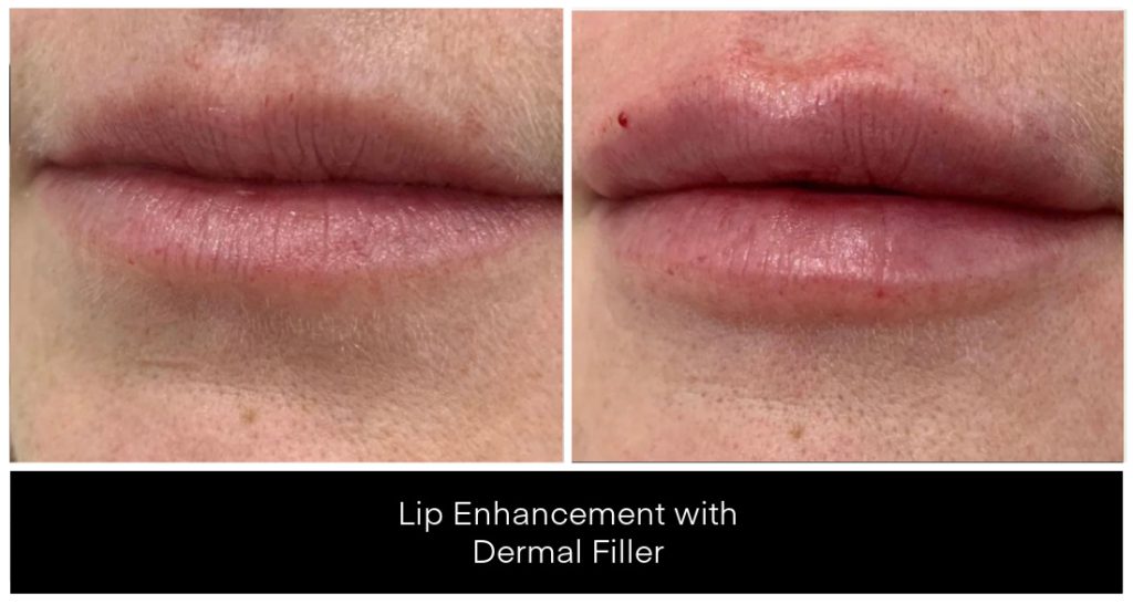 Lip enhancement with dermal filler showing improved fullness and contour on the lips, presented by Yazdani Aesthetics using Juvederm and Restylane fillers.