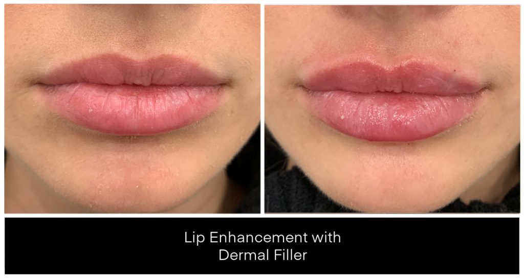 Close-up of lips showing lip filler enhancement with fuller upper and lower lip contours, associated with Yazdani Aesthetics and Juvederm/Restylane