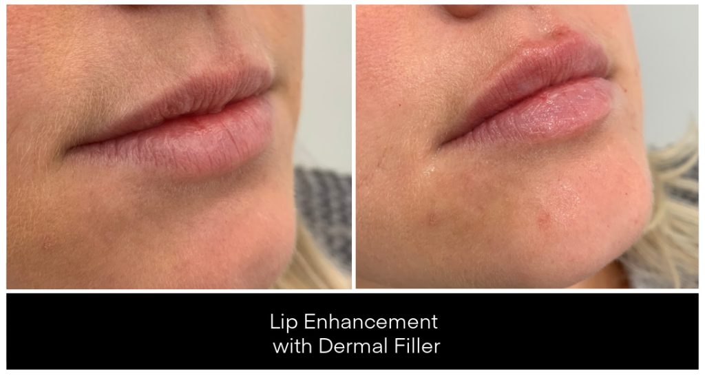 Dermal Filler in London Ontario before and after result