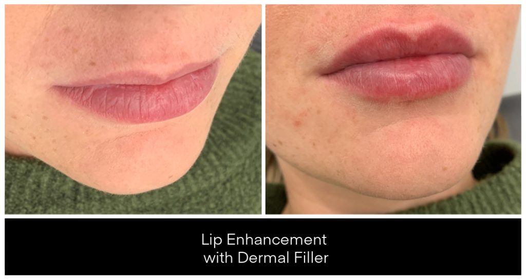 Dermal Filler in London Ontario before and after result