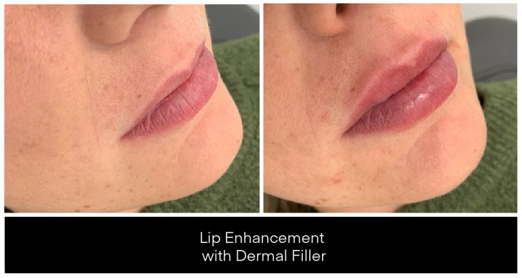 Dermal Filler in London Ontario before and after result