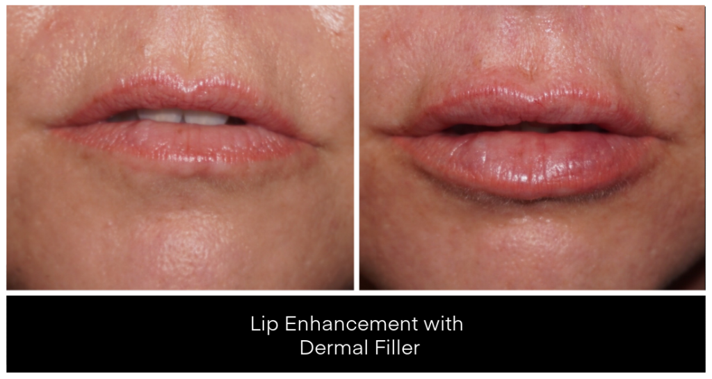 Dermal Filler in London Ontario before and after result