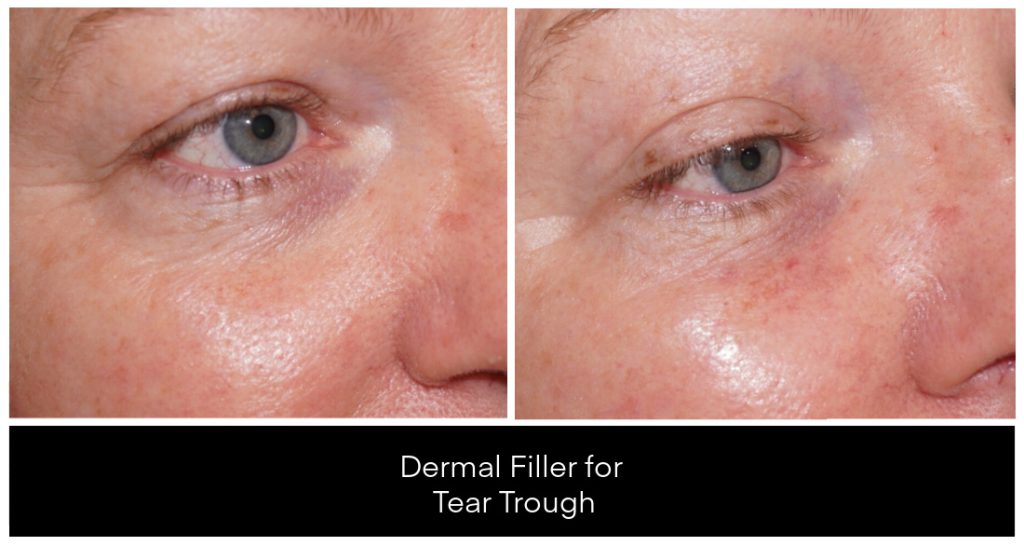 Dermal Filler in London Ontario before and after result