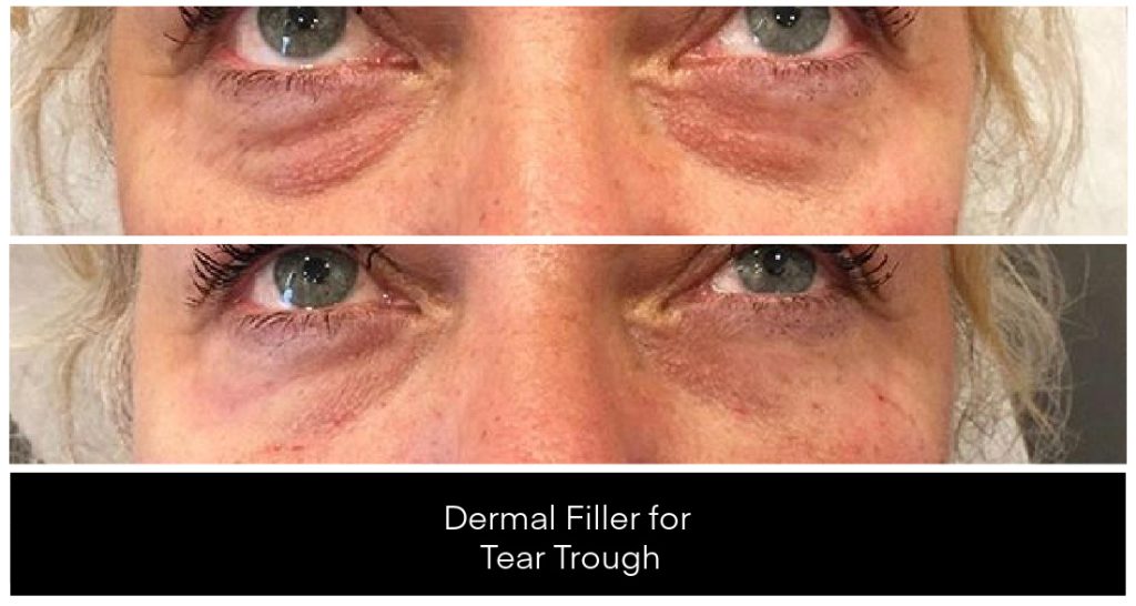 Dermal Filler in London Ontario before and after result