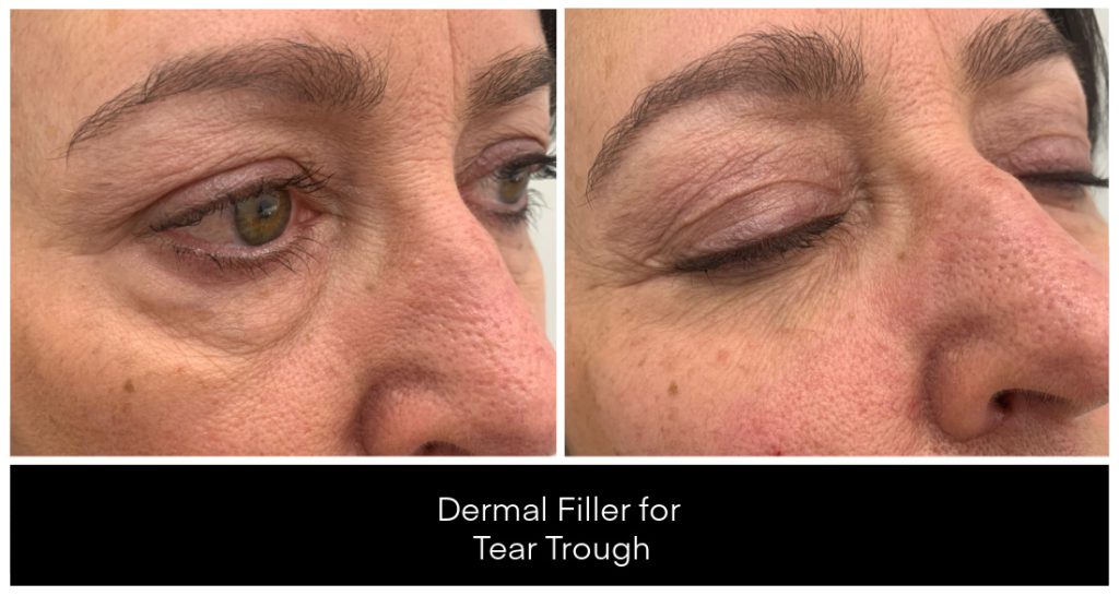 Dermal Filler in London Ontario before and after result