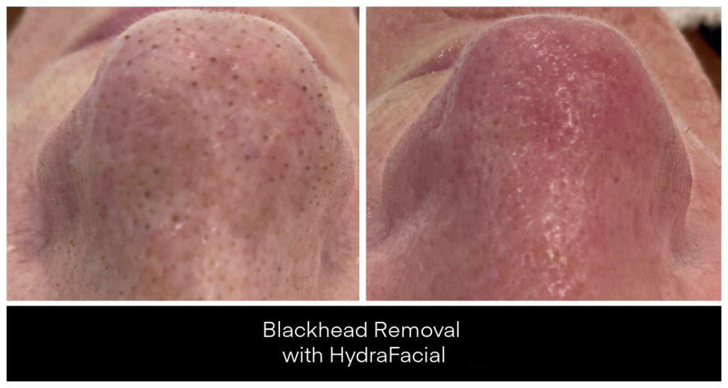 Hydrafacials London Ontario before and after result