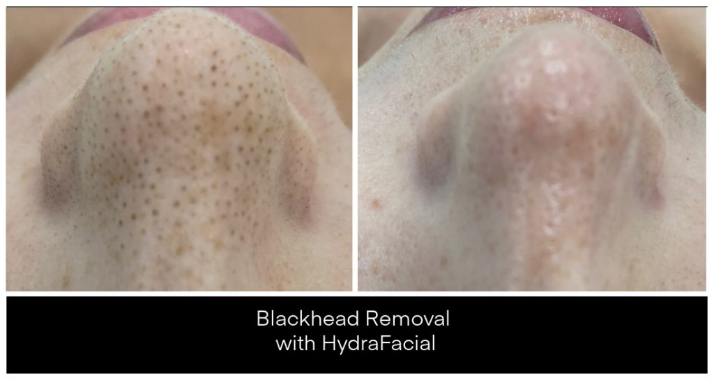 Hydrafacials London Ontario before and after result
