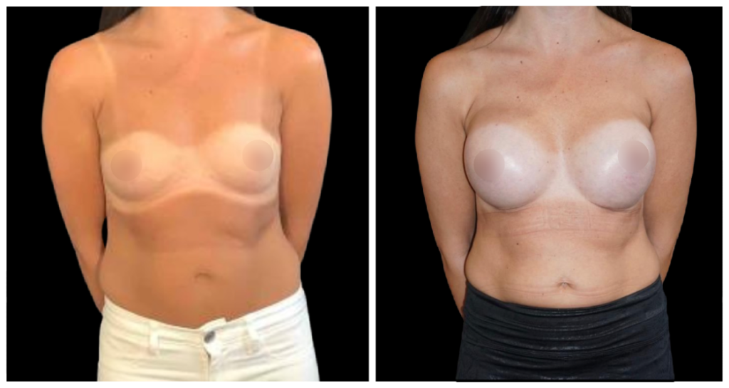 Breast Augmentation in London Ontario before and after result