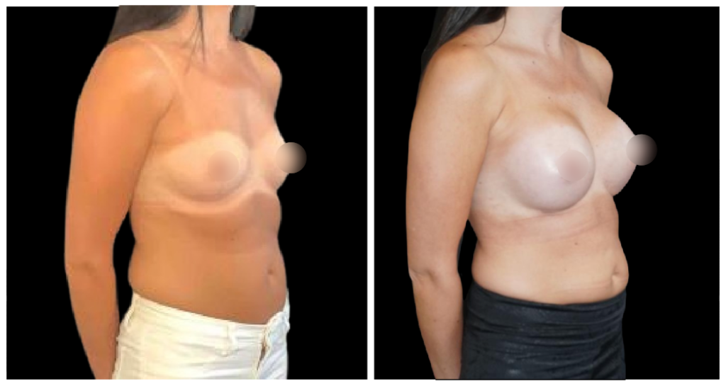 Breast Augmentation in London Ontario before and after result