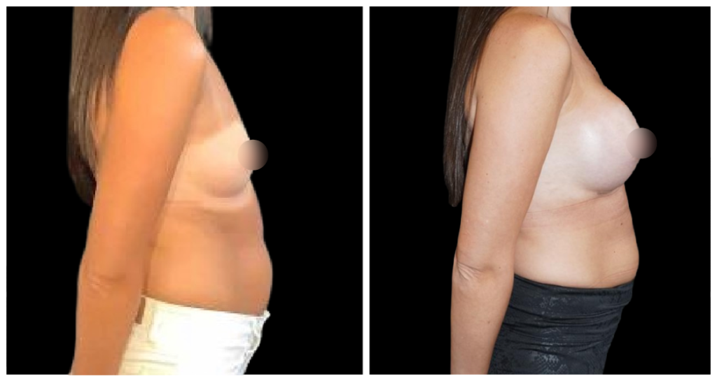 Breast Augmentation in London Ontario before and after result