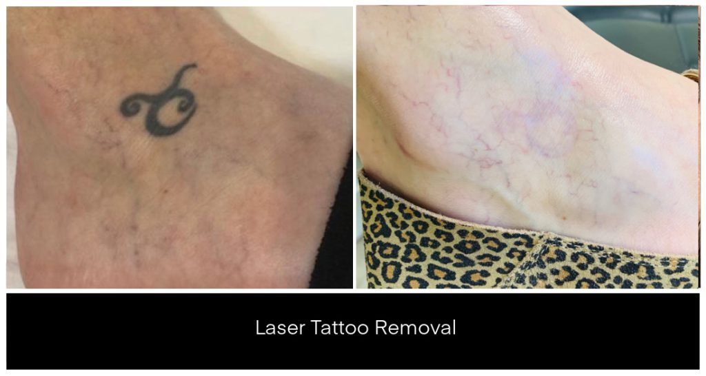 Laser Tattoo Removal in London Ontario before and after result