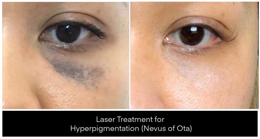 Laser Treatments for Pigmentation before and after result