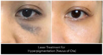 Laser Treatments for Pigmentation before and after result