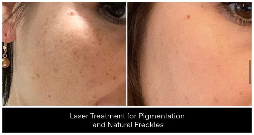 Laser Treatments for Pigmentation before and after result
