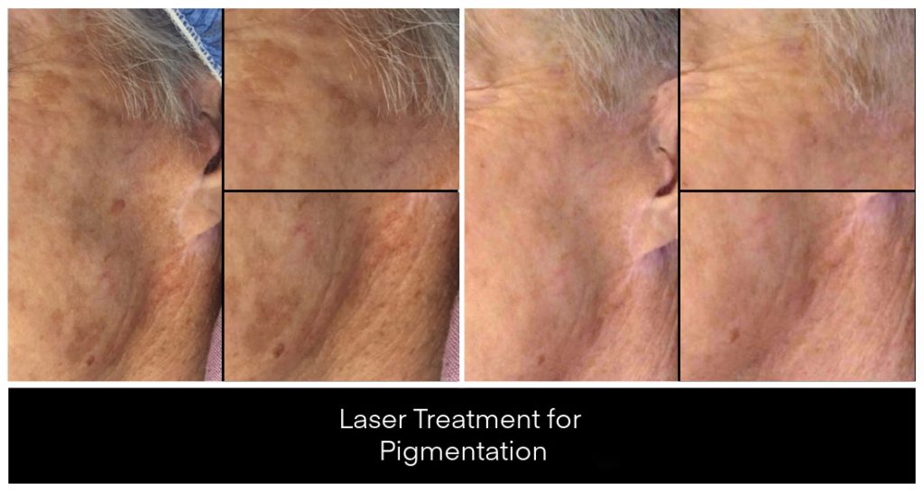 Laser Treatments for Pigmentation before and after result