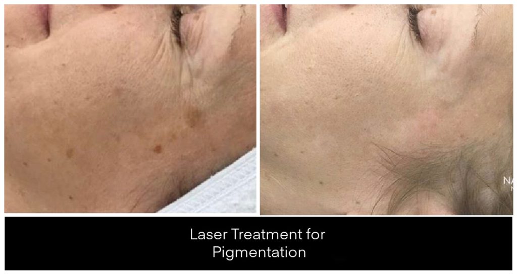 Laser Treatments for Pigmentation before and after result