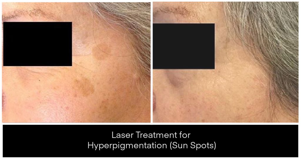 Laser Treatments for Pigmentation before and after result