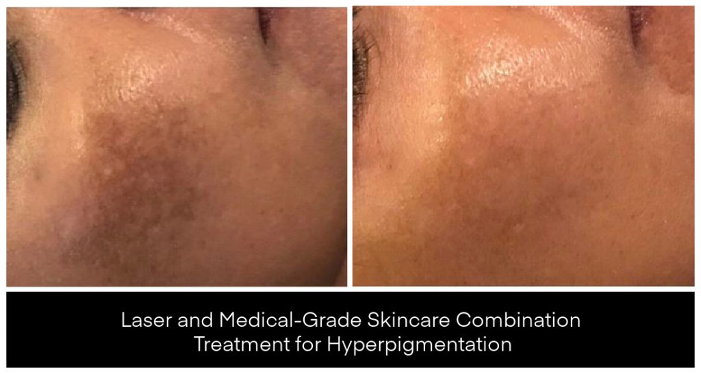 Laser Treatments for Pigmentation before and after result