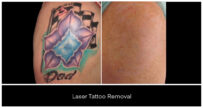 Laser Tattoo Removal in London Ontario before and after result