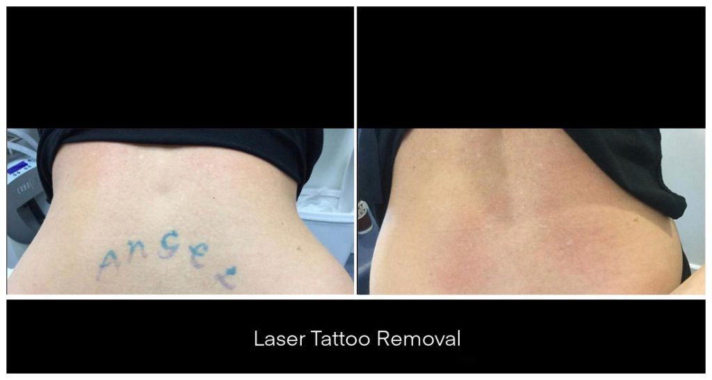 Laser Tattoo Removal in London Ontario before and after result