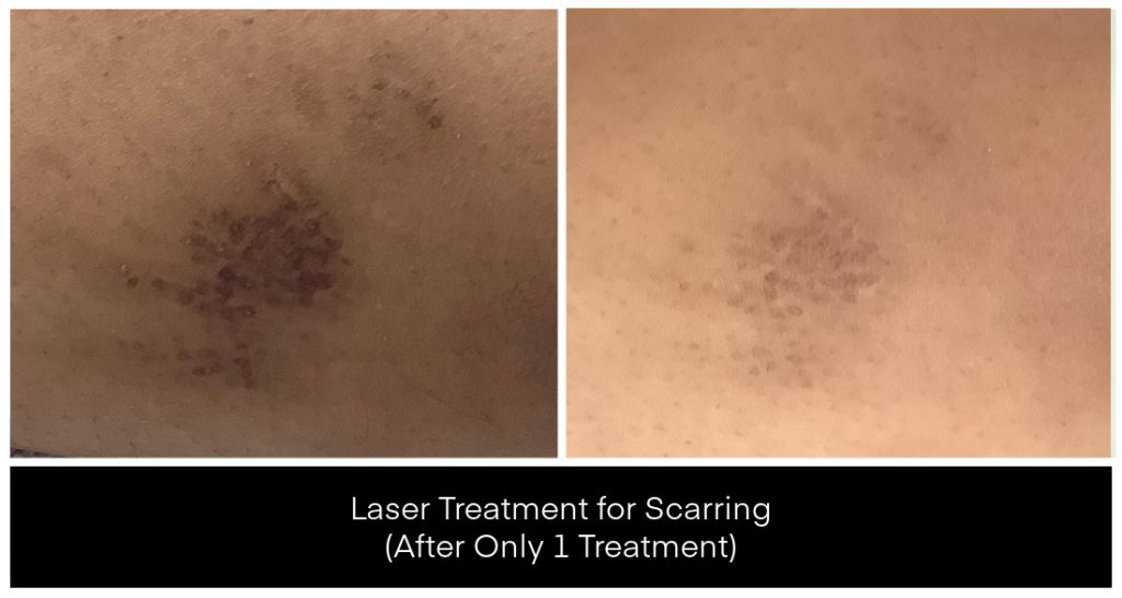 A before-and-after view shows scar reduction from laser treatments for scarring at Yazdani Aesthetics, with improvement after only one treatment.