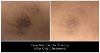 A before-and-after view shows scar reduction from laser treatments for scarring at Yazdani Aesthetics, with improvement after only one treatment.