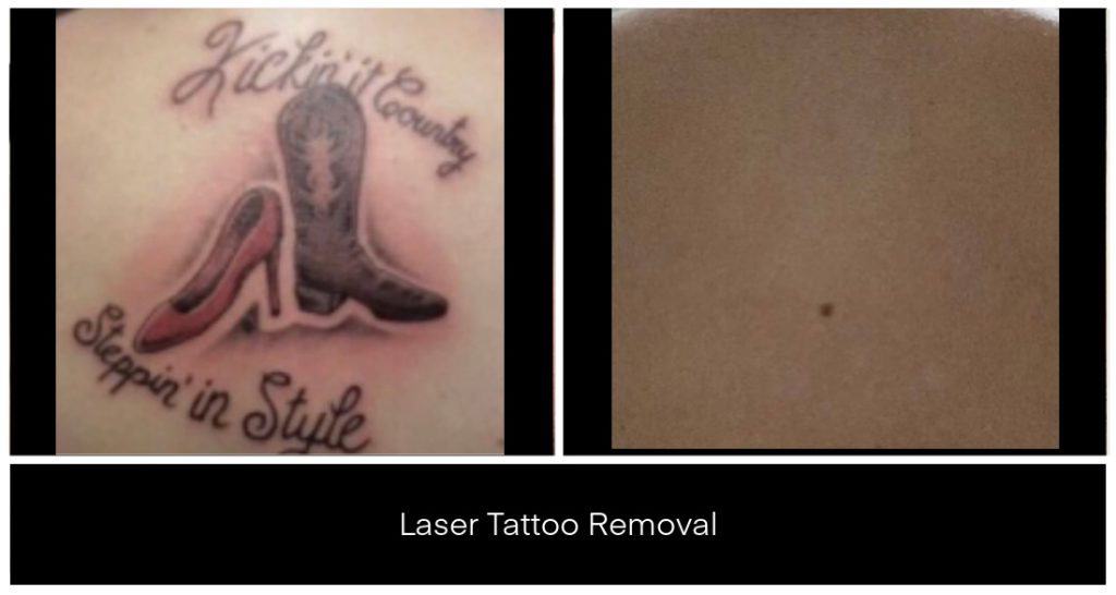PicoSure laser tattoo removal example at Yazdani Aesthetics in London Ontario showing a pink and black boot tattoo on skin and a nearly clear panel with a small dot, highlighting advanced ink removal technology.