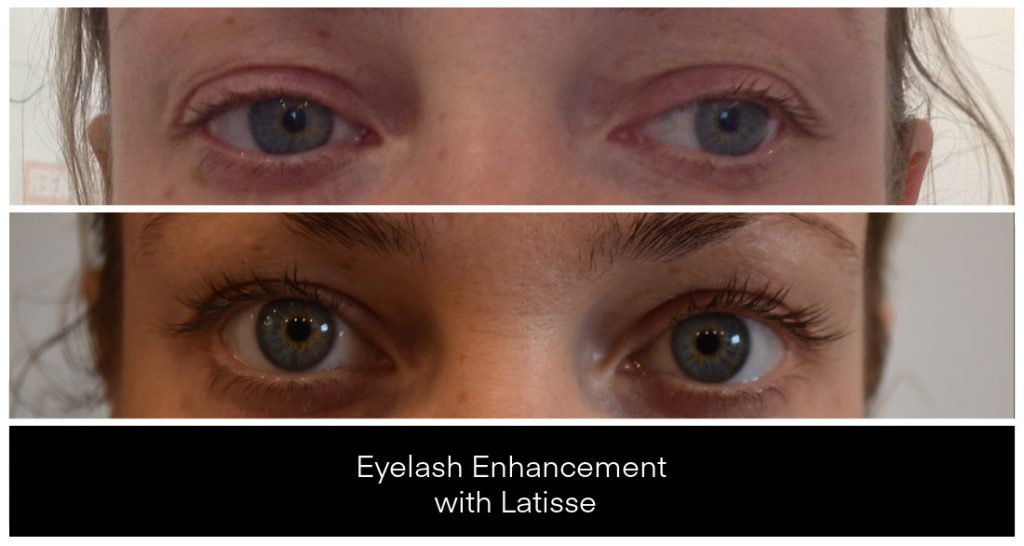 Eyelash Enhancement with LATISSE® before and after result
