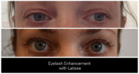 Eyelash Enhancement with LATISSE® before and after result