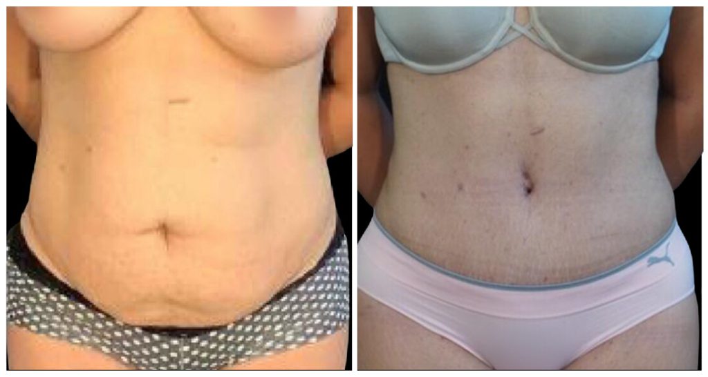 Liposuction in London Ontario before and after result