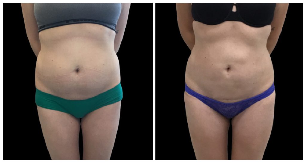 Before and after images of a woman's abdomen showing changes in appearance and skin texture.