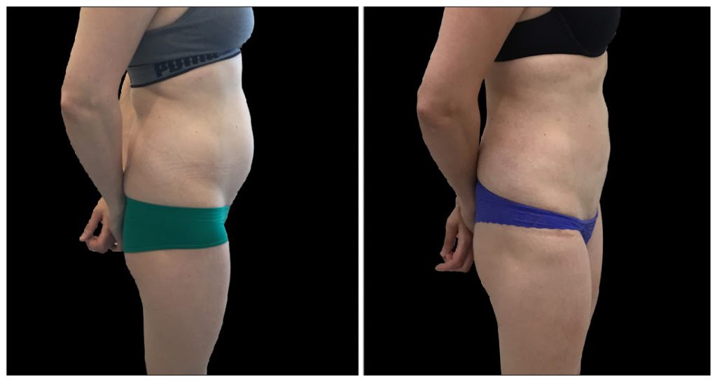 Side view comparison of a woman's body before and after a liposuction procedure, showing changes in body contour and skin appearance.