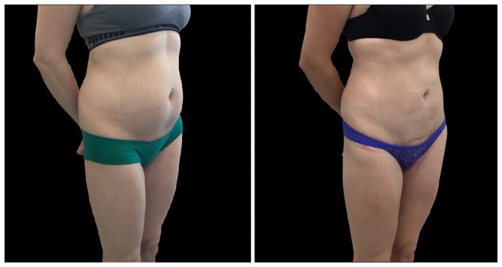 Before and after images of a woman's midsection showing changes in body contour and skin appearance following a cosmetic procedure.