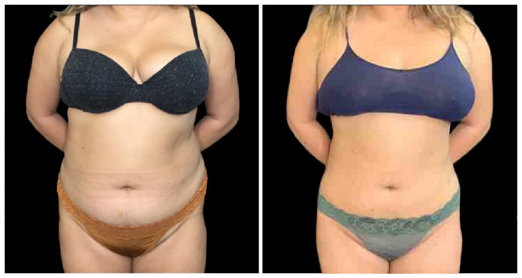 Before and after images of a woman's abdomen showcasing changes in body contour following a liposuction procedure.