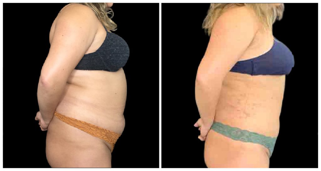 Side-by-side comparison of a woman's torso before and after liposuction, showing changes in body contour and skin appearance.