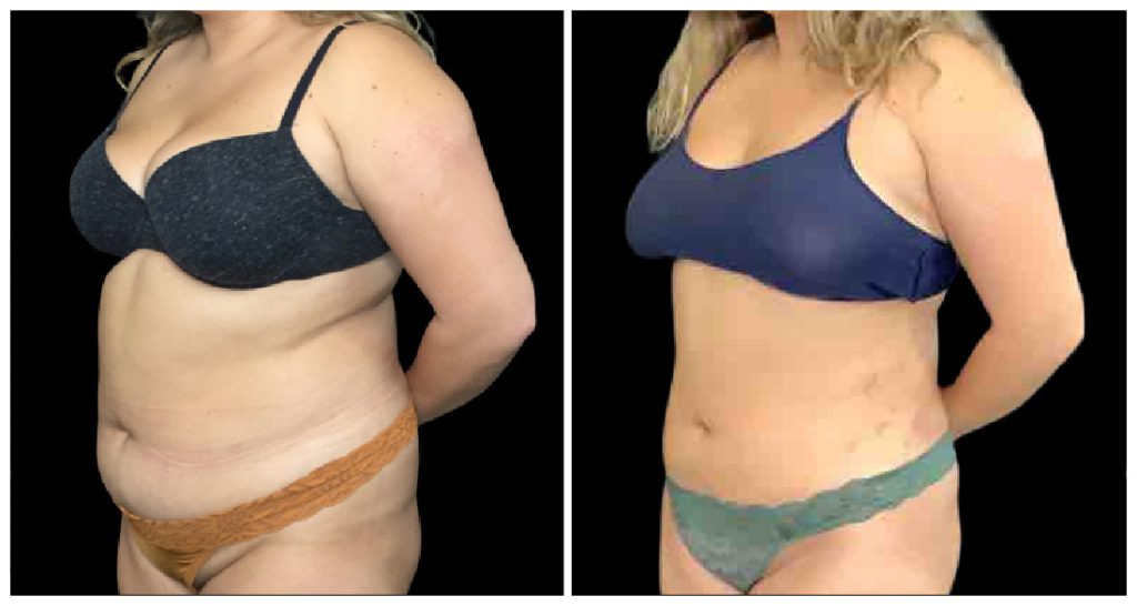 Before and after images of a woman's torso showing changes in body contour and shape following a liposuction procedure.
