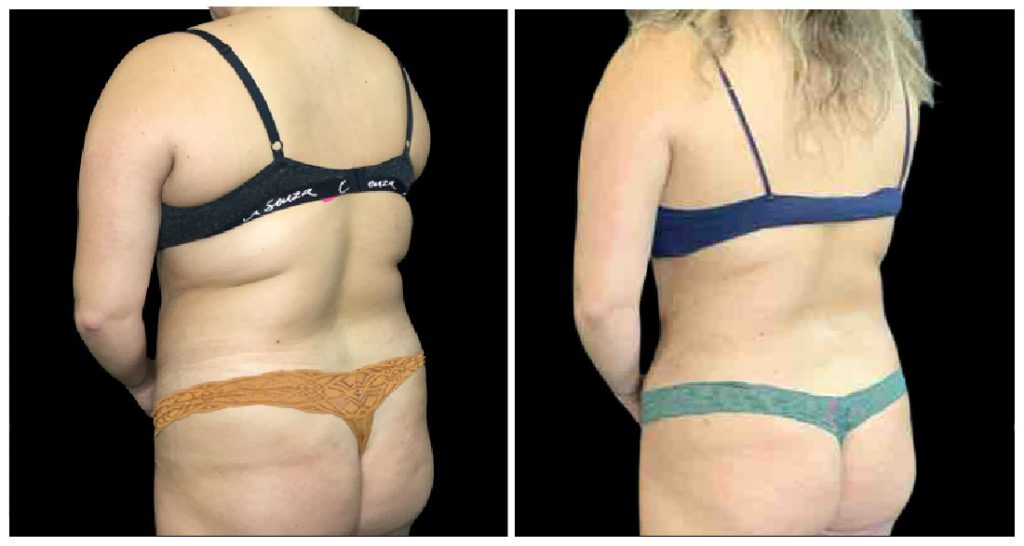 Before and after images of a woman's back showing body contouring results with different underwear styles.